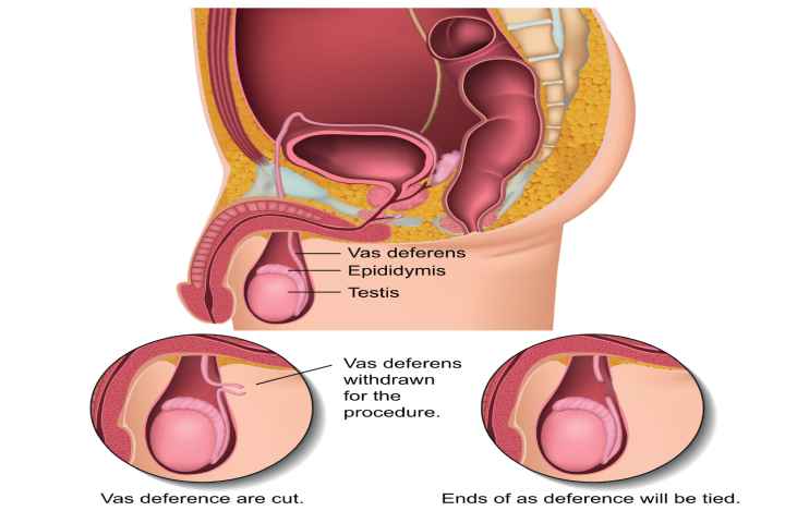 Vasectomy pic1