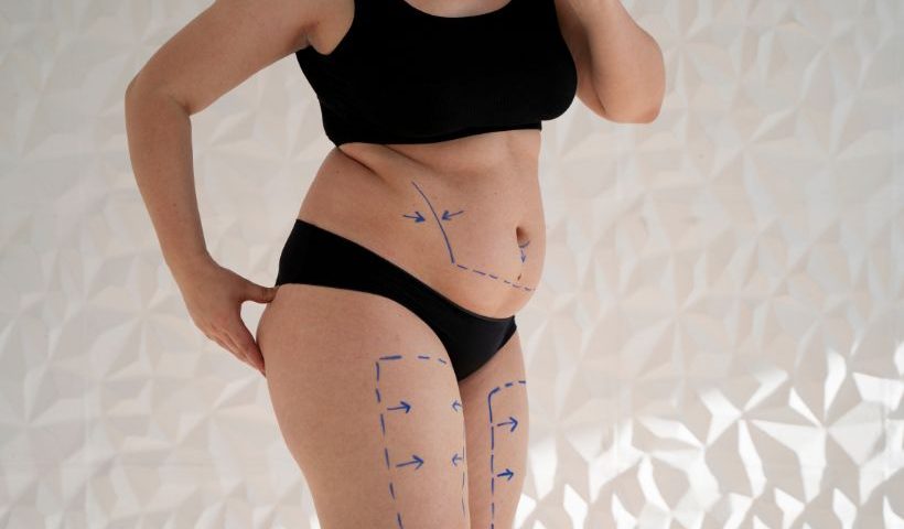 Lipedema What It Is, Symptoms And Treatment