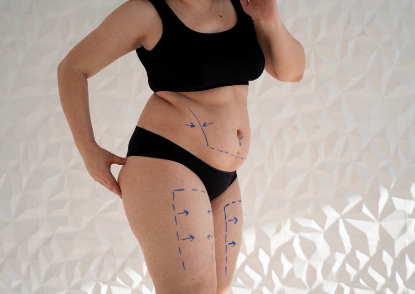 Lipedema What It Is, Symptoms And Treatment