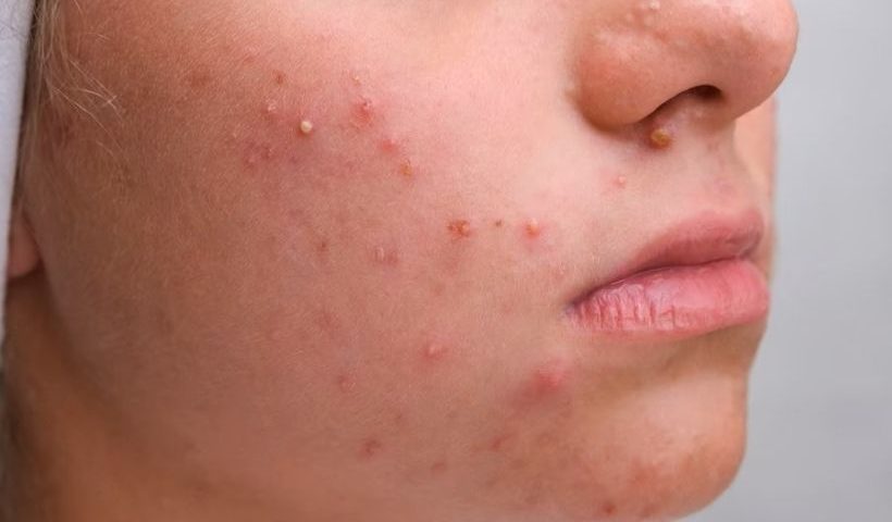 Tips To Get Rid Of A Pimple Quickly