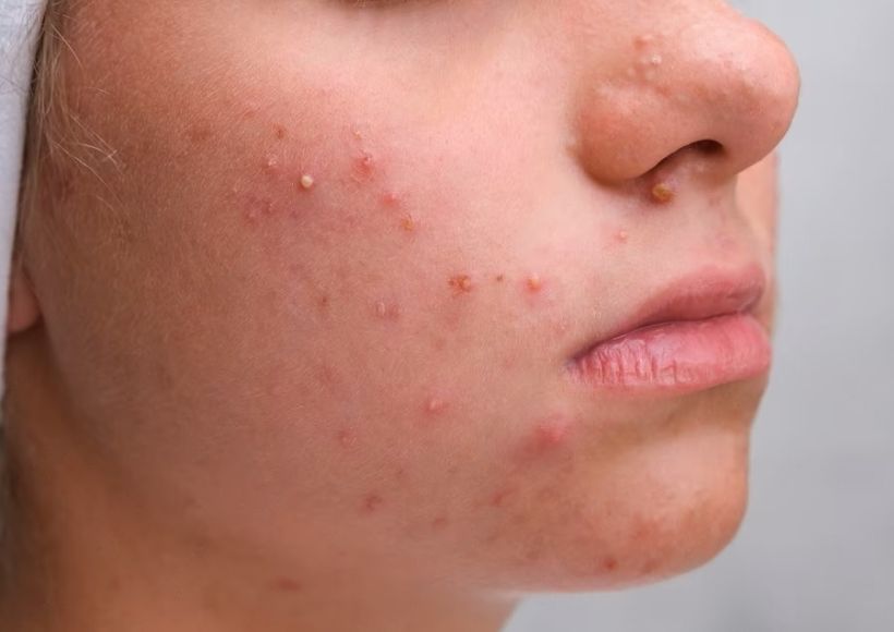 Tips To Get Rid Of A Pimple Quickly